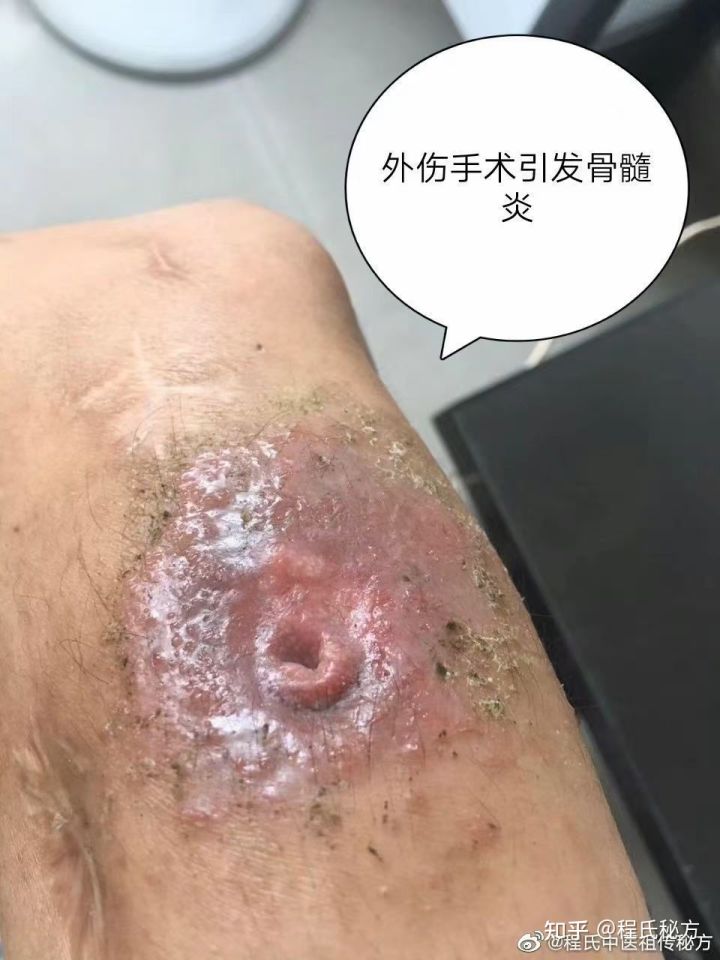 骨髓炎伤口用什么药效果好